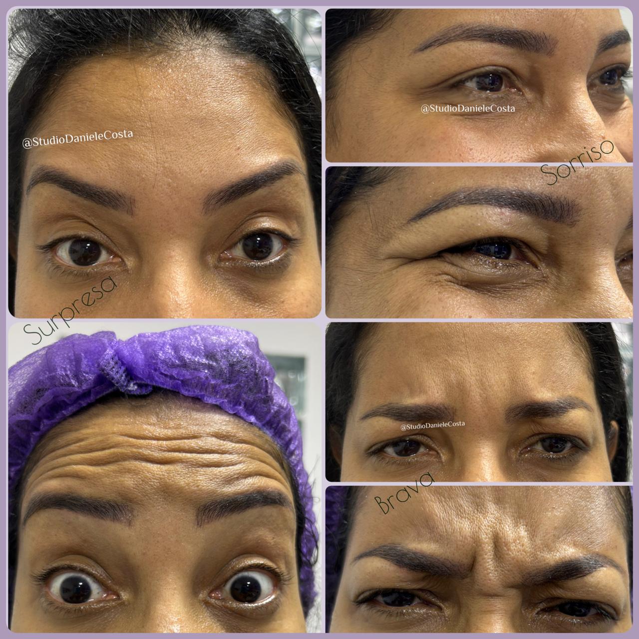 Estética Avançada - Harmonização facial